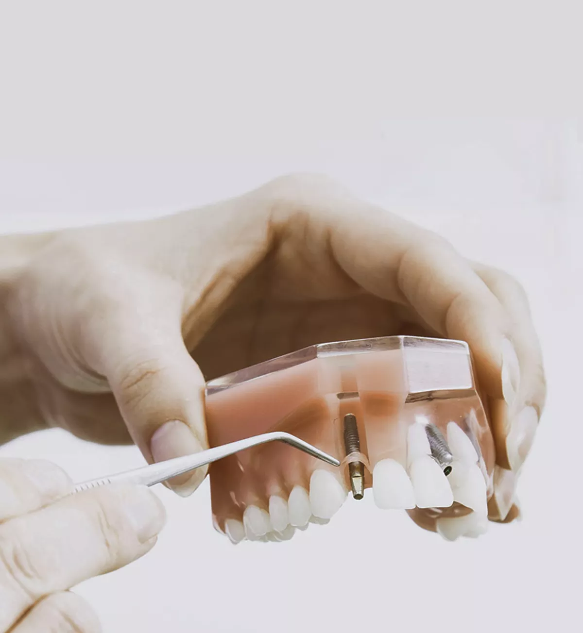 beneficios-implantes-dentales